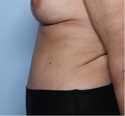 Tummy Tuck Before & After Patient #34291